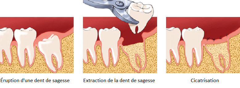 Extraction Dents De Sagesse Chirurgien Dentiste Dr Laurine Birault