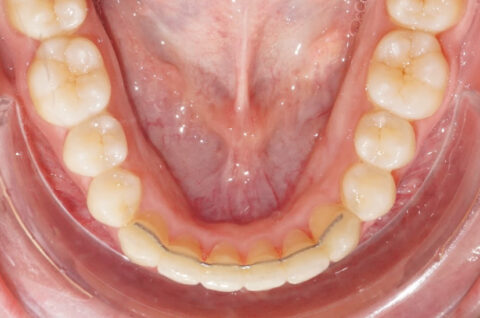 Le fil de contention en orthodontie