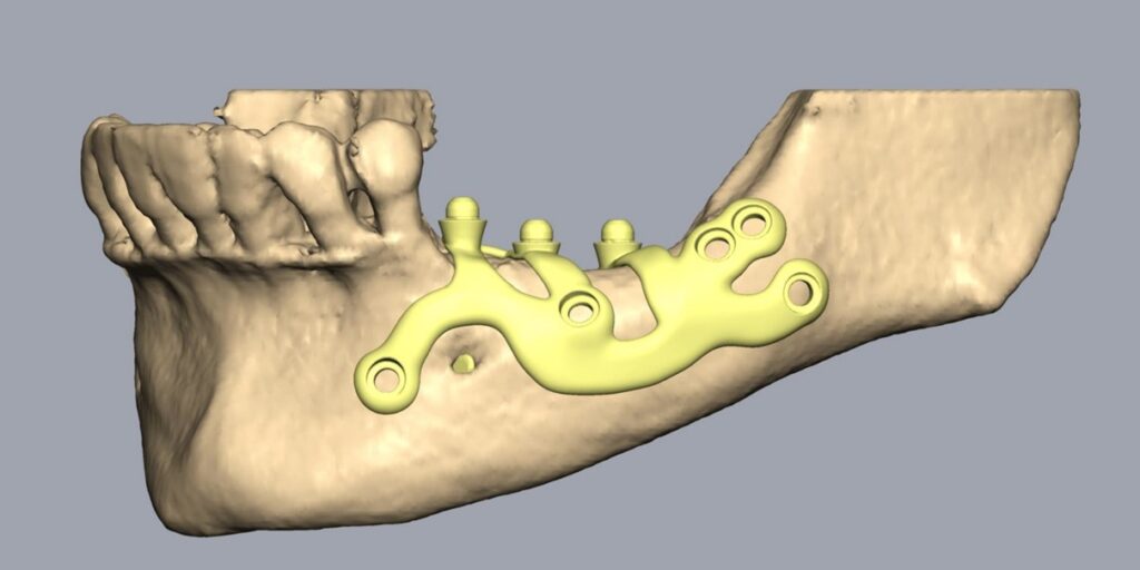 fabrication implant sous perosite