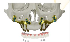 implant sans greffe osseuse