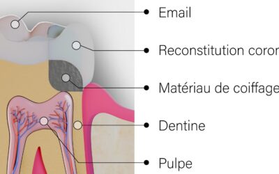 Le coiffage de la plaie pulpaire