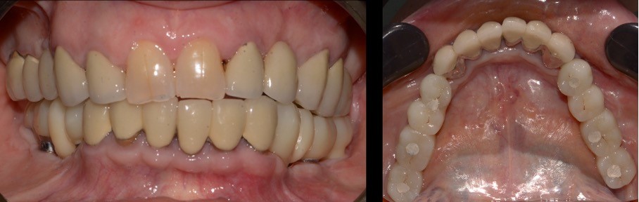 couronne ceramique implant sous periostes