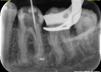 Endodontie : Aïe c’est la fracture ! Que faire ?