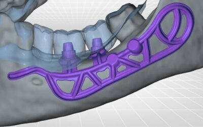 Implants sous périostés et mâchoire inférieure