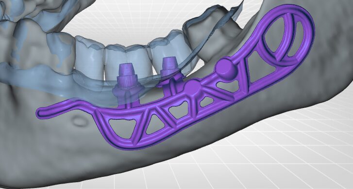 implant sous perioste unilateral