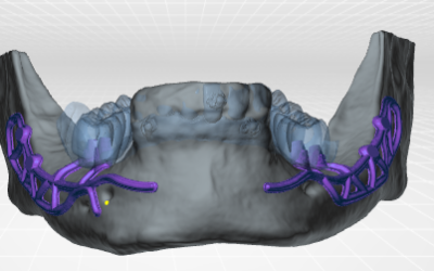 Implants sous-périostés et mâchoire inférieure