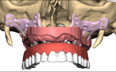 Implants sous-périostés et mâchoires supérieures