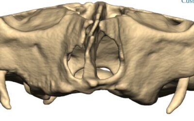 Implants sous périostés et mâchoires supérieures