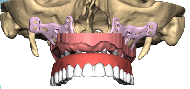 Bridge transvissé sur les implants