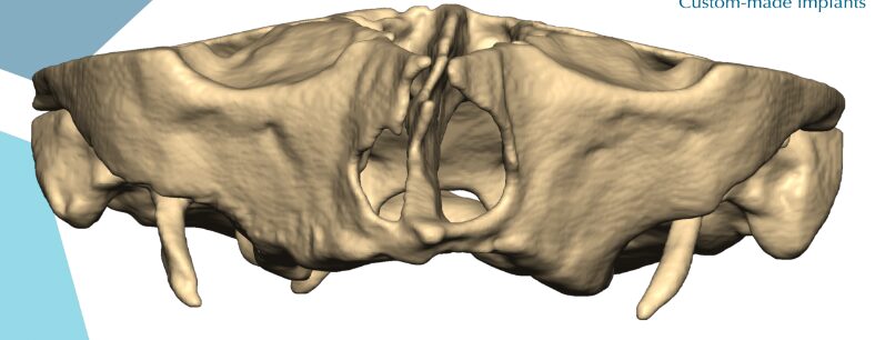 Maxilaire 3D absence os