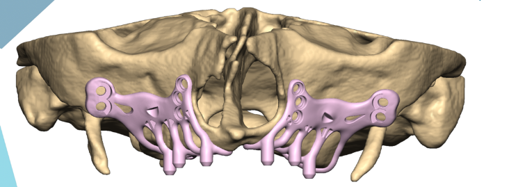 Maxilaire 3D