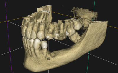 Intégration d’un implant sous-périosté à 2 ans