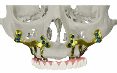 Qu’est-ce qu’un implant sous-périosté ?