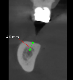 implant sous périosté 