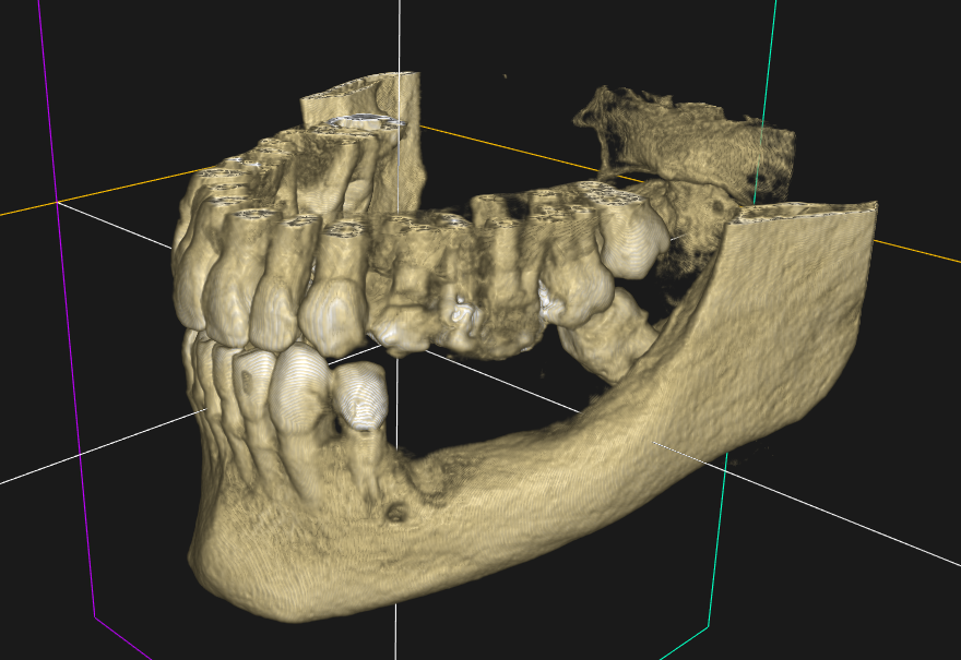 implant sous périosté