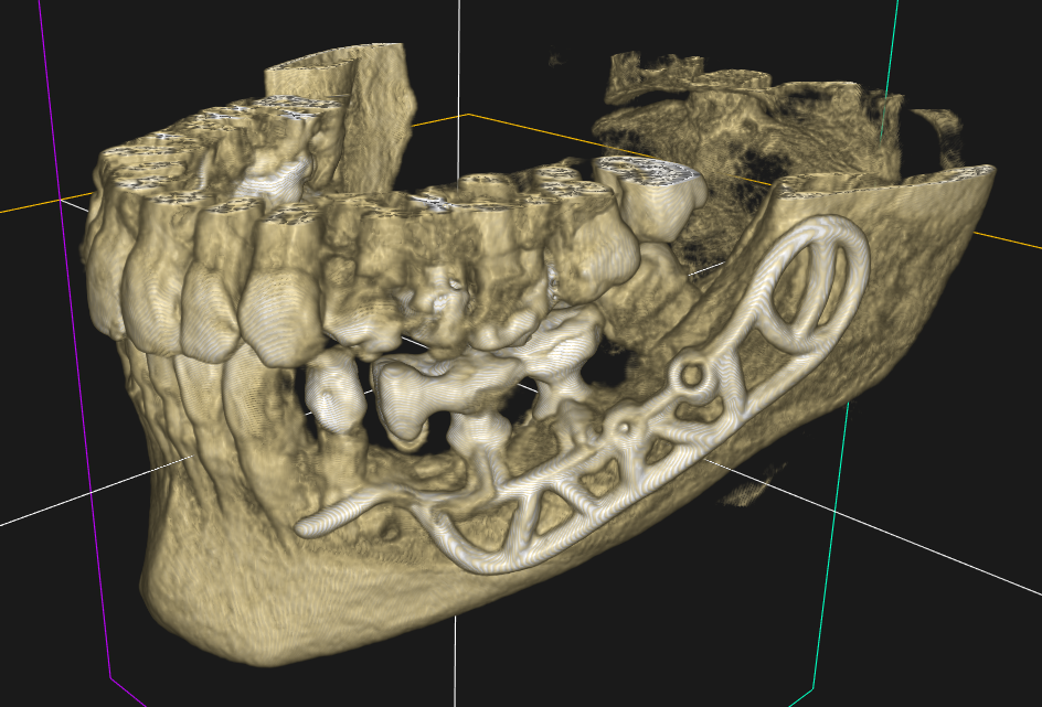 implants conventionnels